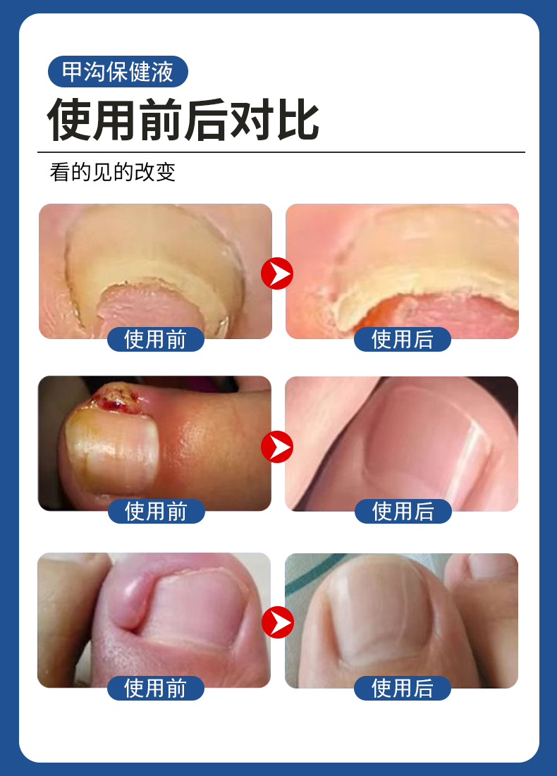 甲溝炎專用液有用嗎？使用前后對(duì)比